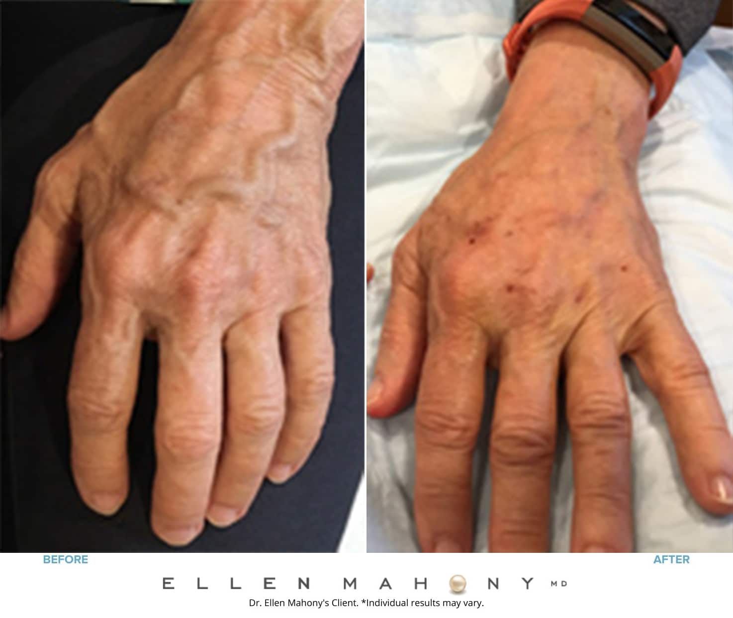 Before and After Image: Case #8537 - front