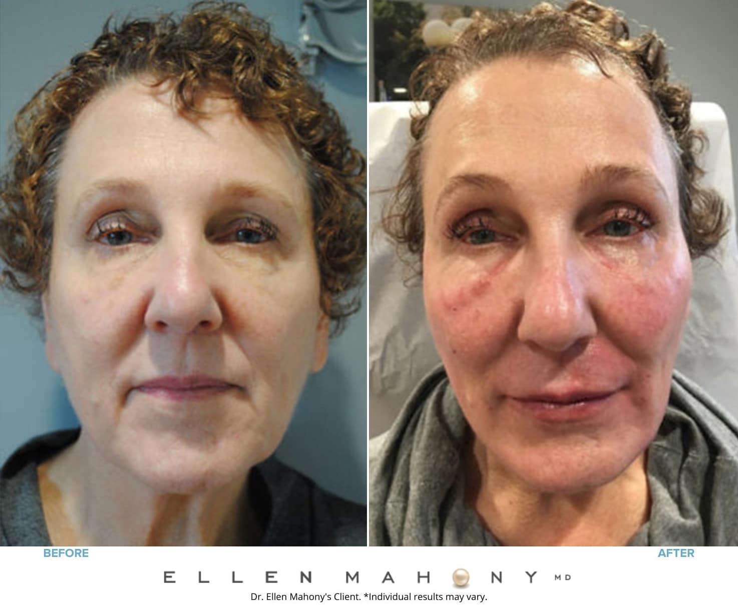 Before and After Image: Case #8563 - front
