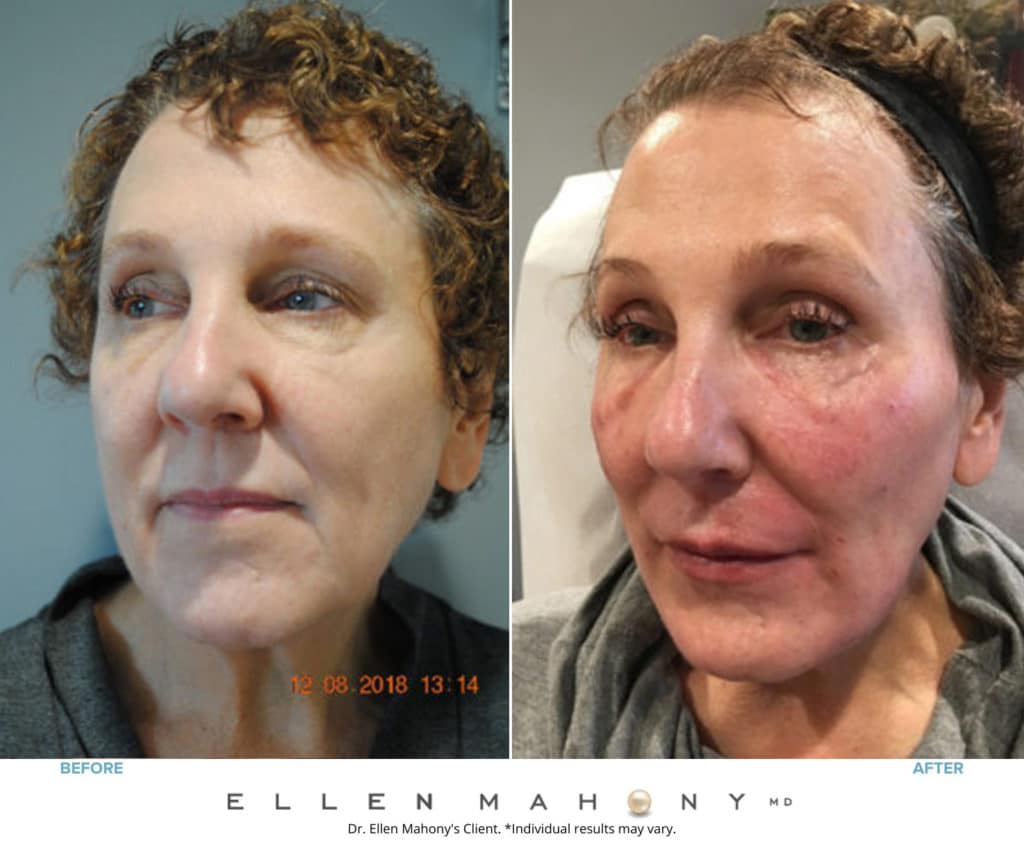 Before and After Image: Case #8563 - left-front-oblique