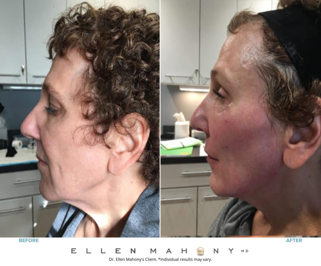 Before and After Image: Case #8563 - left-side