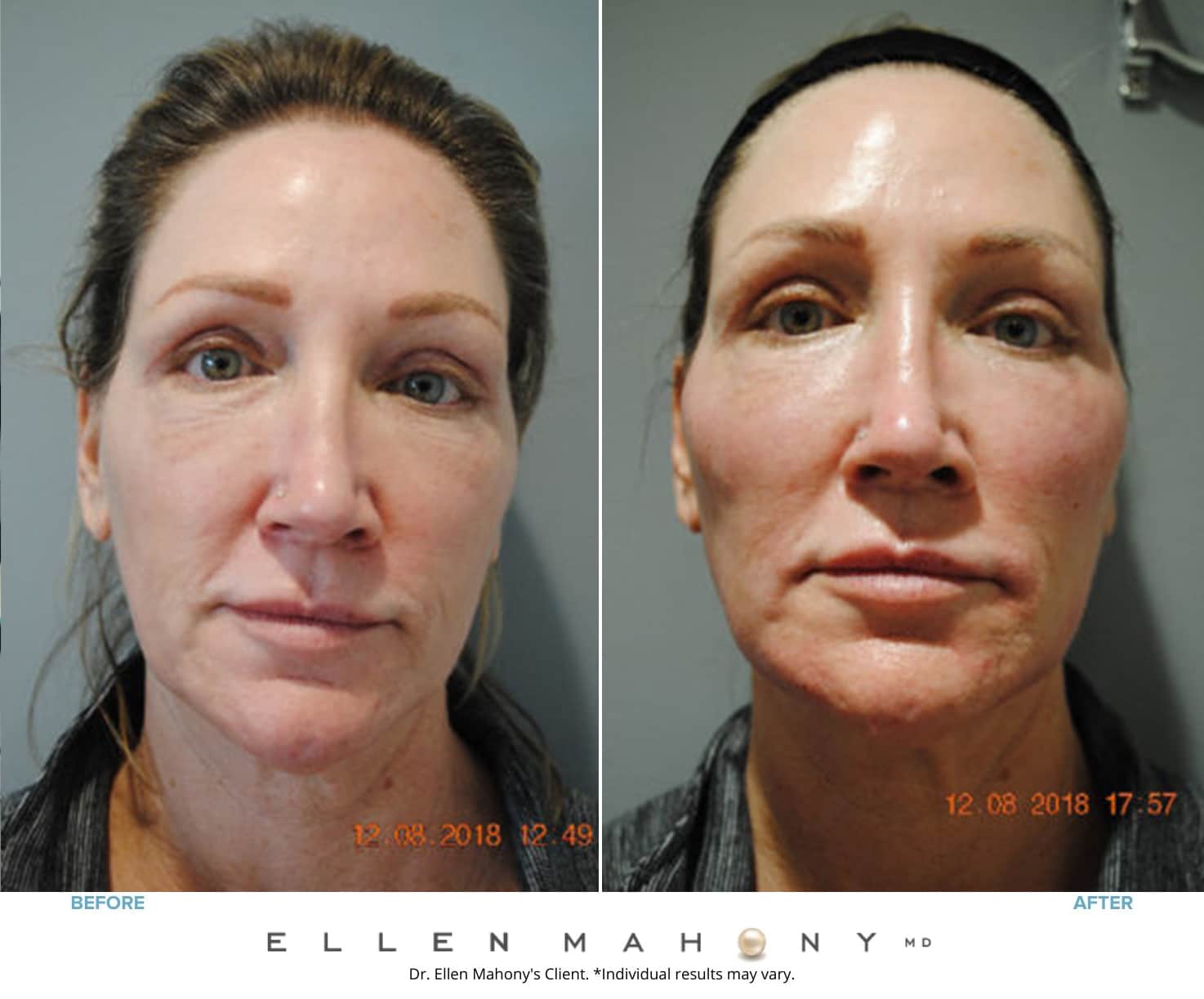 Before and After Image: Case #8602 - front