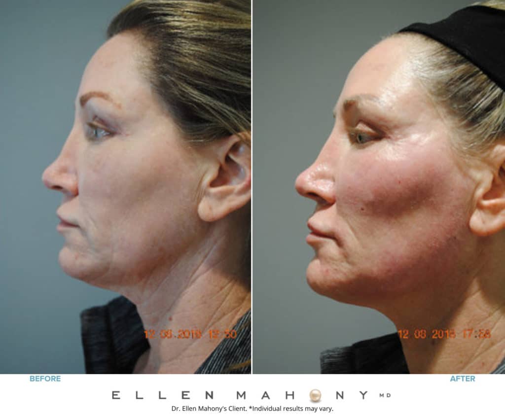 Before and After Image: Case #8602 - left-side