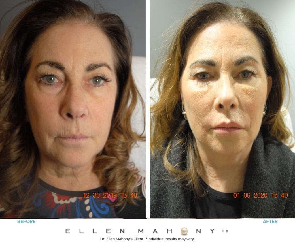 Before and After Image: Case #8729 - front