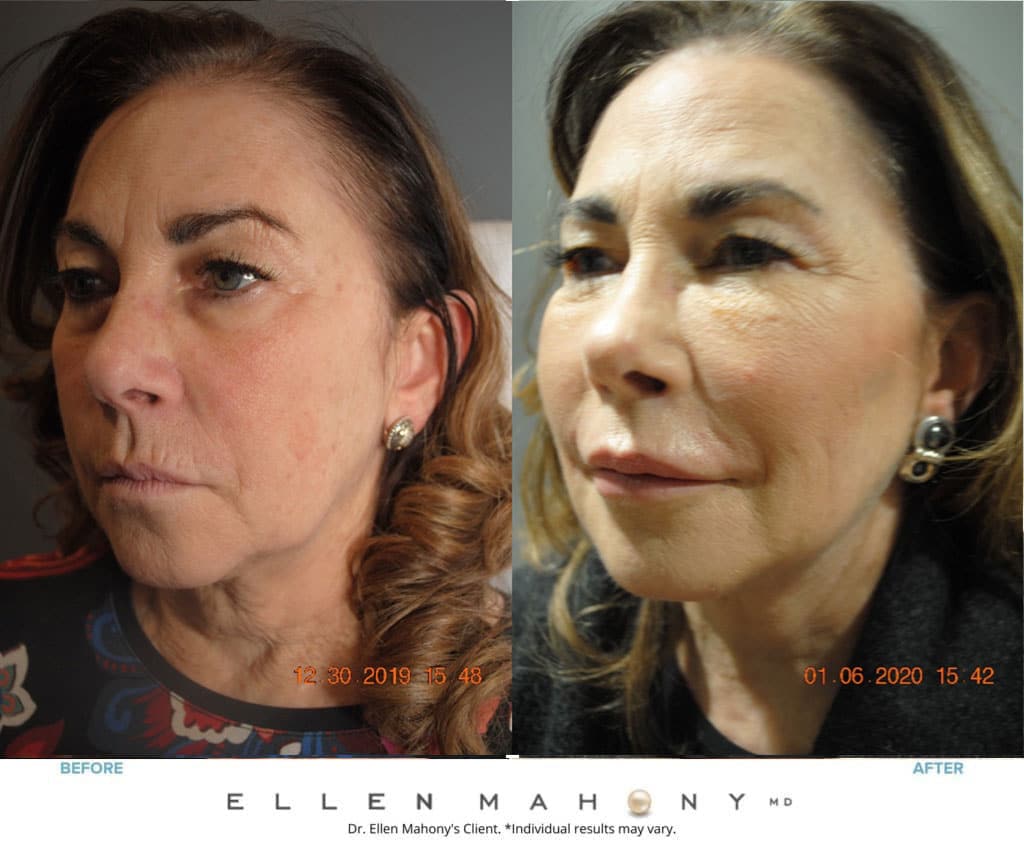 Before and After Image: Case #8729 - left-front-oblique