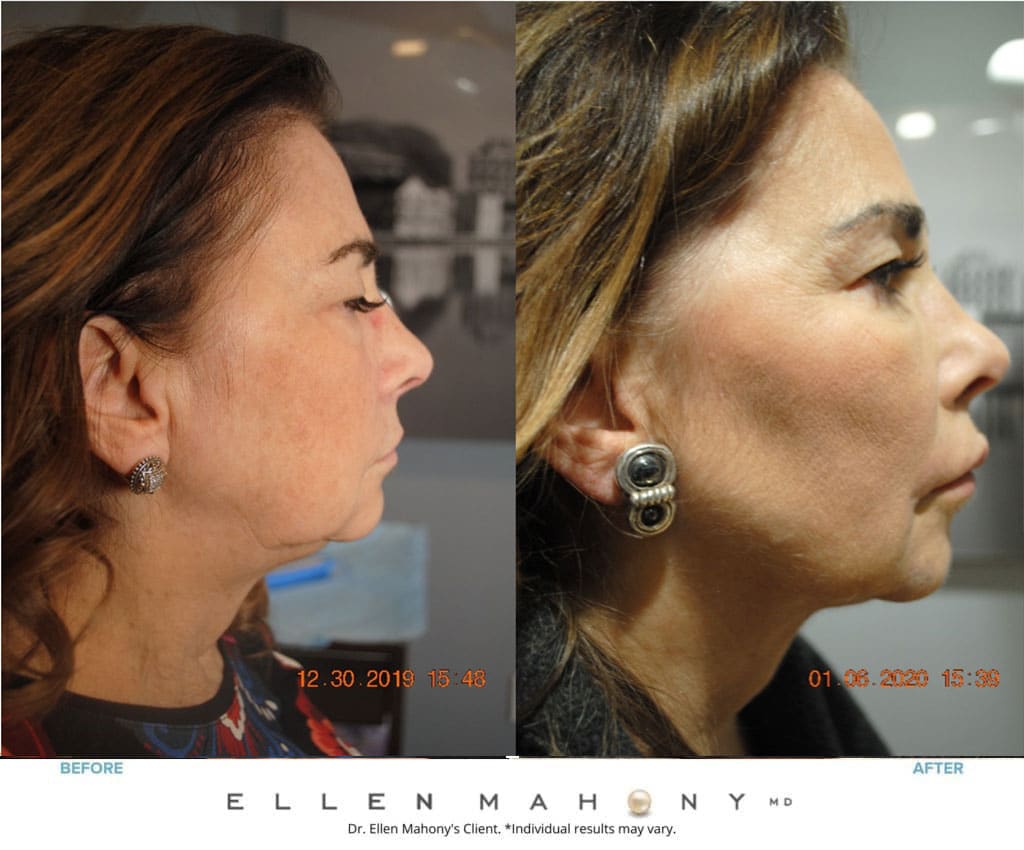 Before and After Image: Case #8729 - right-side