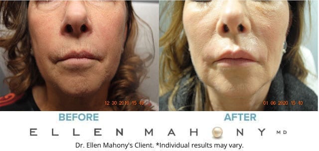Before and After Image: Case #8729 - front