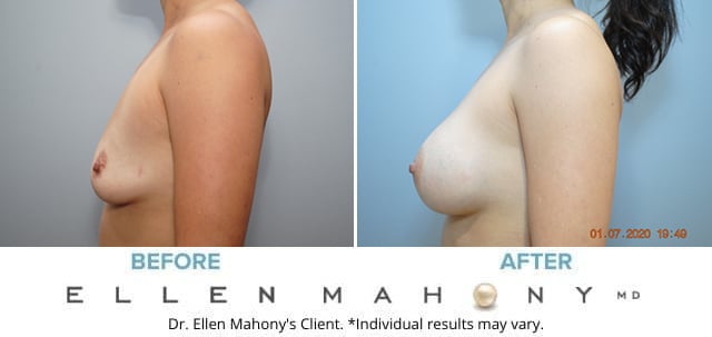 Before and After Image: Case #8504 - left-side