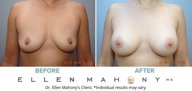 Before and After Image: Case #8504 - front