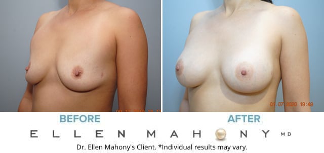Before and After Image: Case #8504 - left-front-oblique