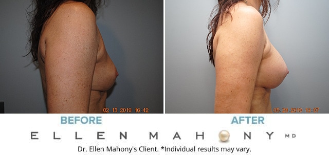 Before and After Image: Case #7856 - right-side