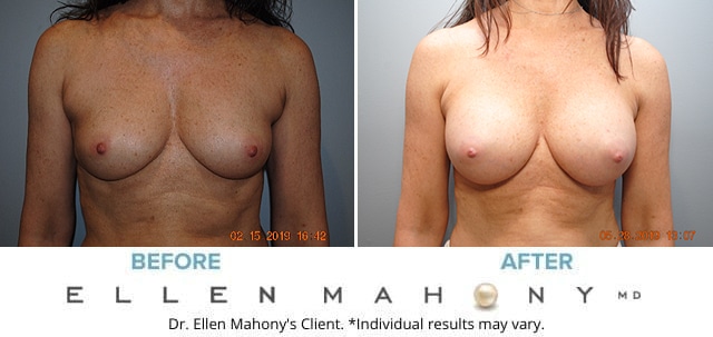 Before and After Image: Case #7856 - front