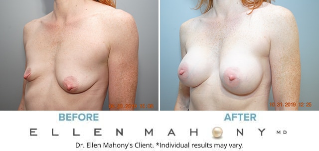 Before and After Image: Case # 8150 - left-front-oblique