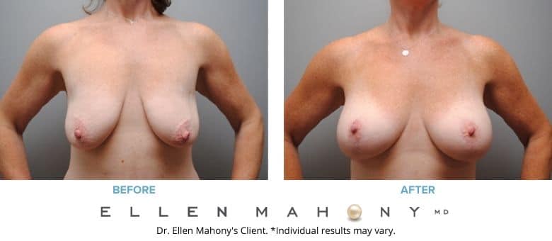 Before and After Image: Case #2758 - front