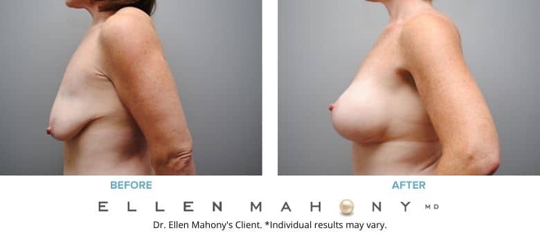 Before and After Image: Case #2758 - left-side