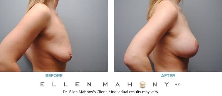 Before and After Image: Case #2772 - right-side