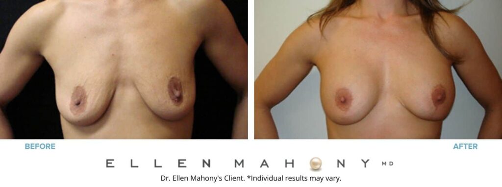 Before and After Image: Case #2821 - front