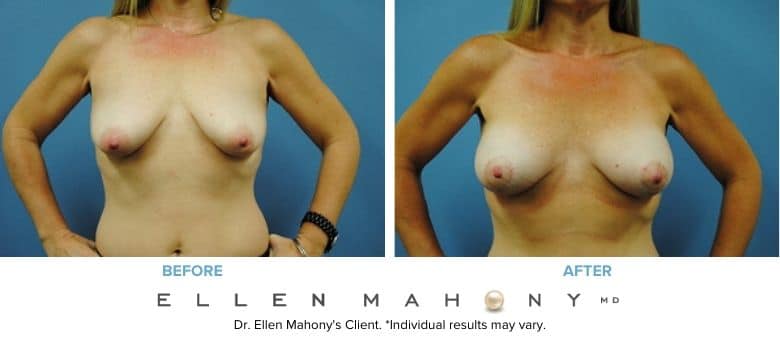 Before and After Image: Case #2999 - front