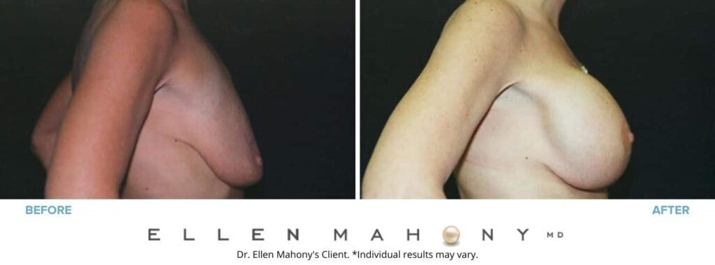 Before and After Image: Case #3167 - right-side