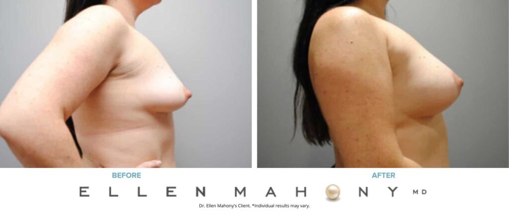 Before and After Image: Case #7068 - right-side