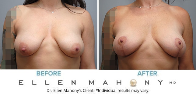 Before and After Image: Case #9603 - front