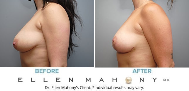 Before and After Image: Case #9603 - left-side