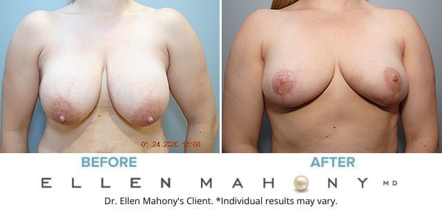 Before and After Image: Case #8594 - front