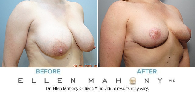 Before and After Image: Case #8594 - right-front-oblique