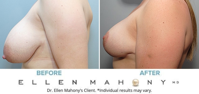 Before and After Image: Case #8594 - left-side