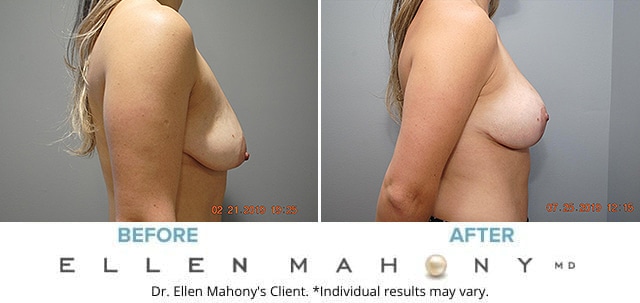 Before and After Image: Case #2820 - right-side