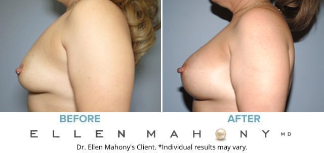 Before and After Image: Case #6817 - left-side