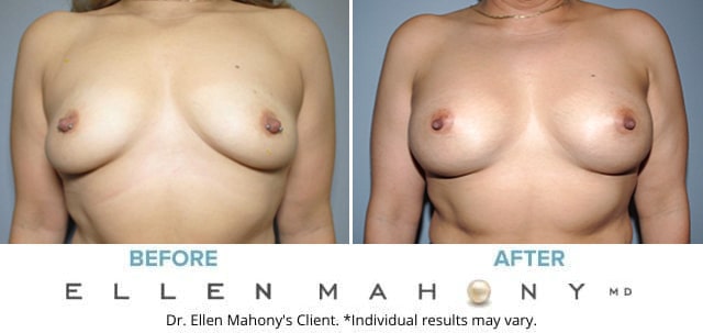 Before and After Image: Case #6817 - front