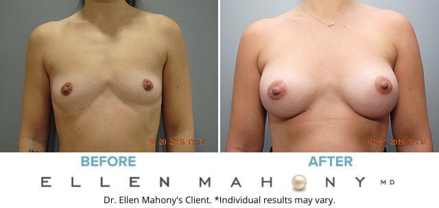 Before and After Image: Case #7485 - front
