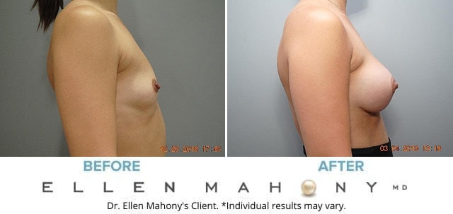 Before and After Image: Case #7485 - right-side