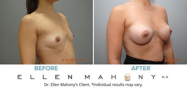 Before and After Image: Case #7485 - right-front-oblique