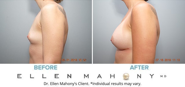 Before and After Image: Case #7976 - left-side