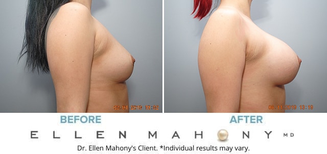 Before and After Image: Case #8062 - right-side