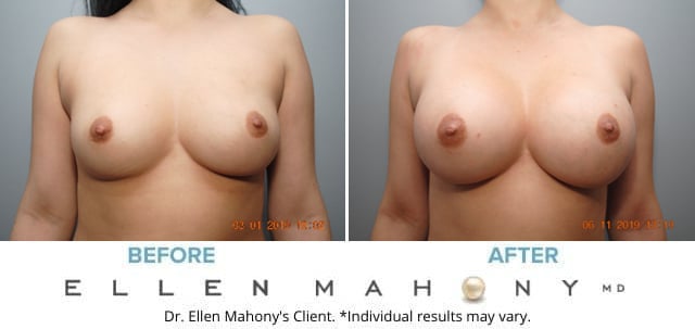 Before and After Image: Case #8062 - front
