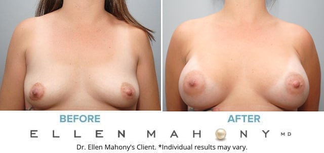 Before and After Image: Case #8256 - front