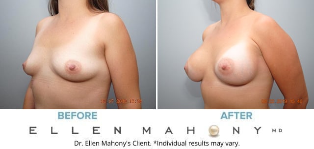Before and After Image: Case #8256 - left-front-oblique