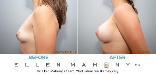 Before and After Image: Case #8256 - left-side