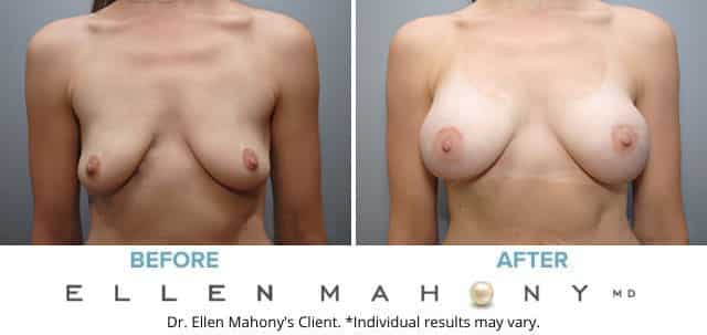 Before and After Image: Case #8328 - front