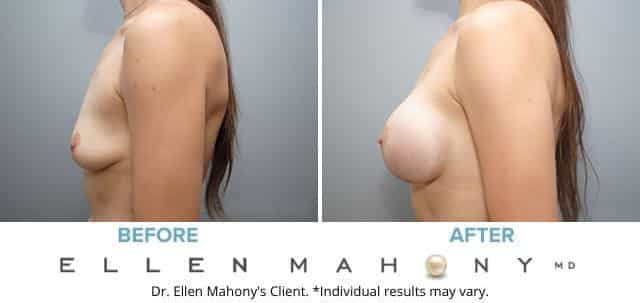 Before and After Image: Case #8328 - left-side