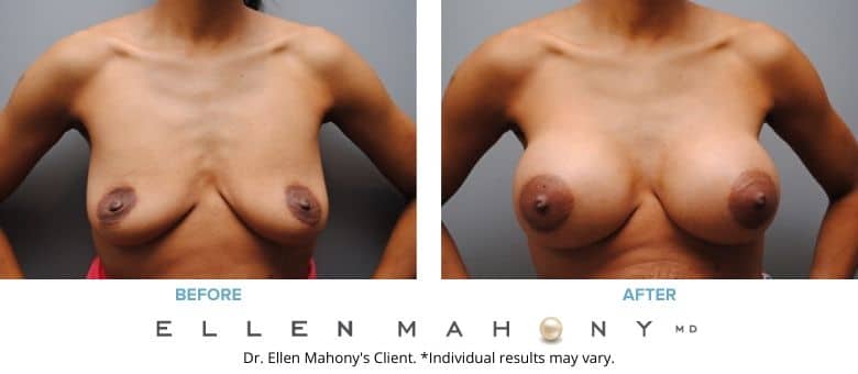 Before and After Image: Case #2779 - front