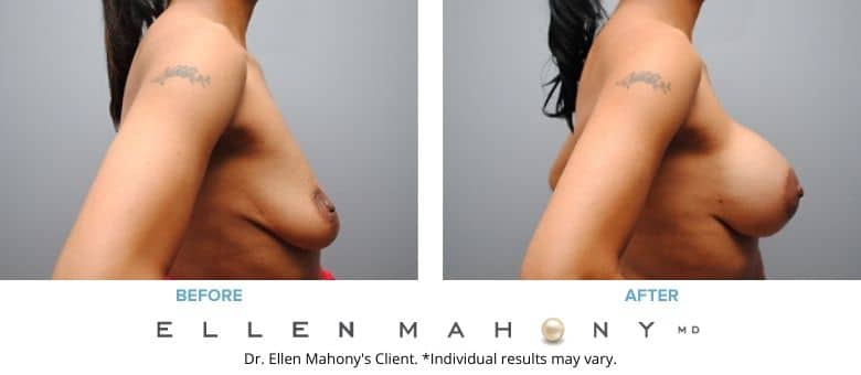 Before and After Image: Case #2779 - right-side