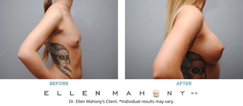 Before and After Image: Case #2786 - right-side