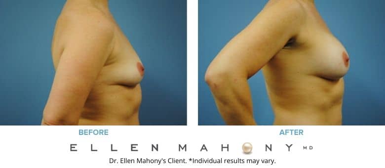 Before and After Image: Case #2800 - right-side