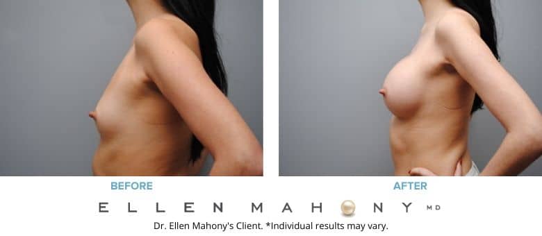 Before and After Image: Case #2807 - left-side