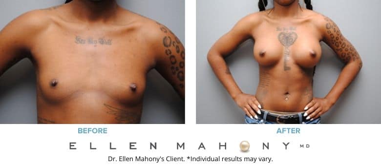 Before and After Image: Case #2814 - front