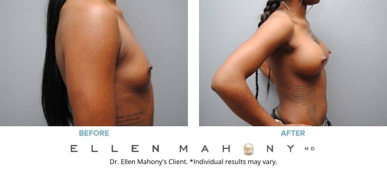 Before and After Image: Case #2814 - right-side