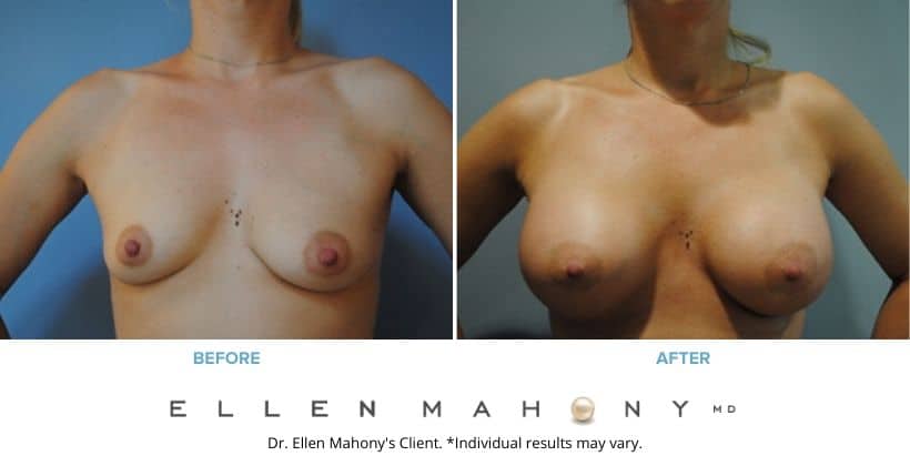 Before and After Image: Case #2826 - front